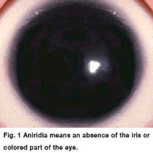 Image of an eye with Aniridia