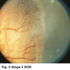 Retinopathy of Prematurity - Eyes 4 Kids