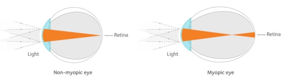 Non myopic eye vs myopic eye