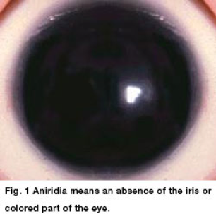 Image of an eye with Aniridia