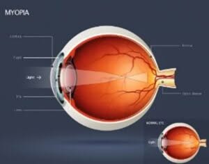 Myopia Managment